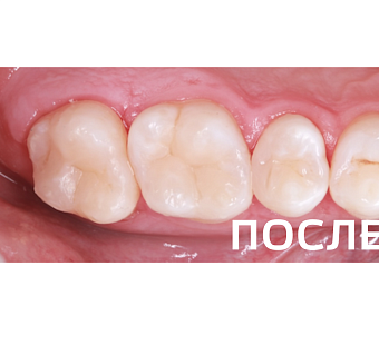 Лечение  кариеса