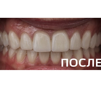 Комплексное ортопедическое восстановление зубных рядов 
