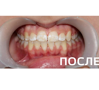 Исправление прикуса, выравнивание зубов
