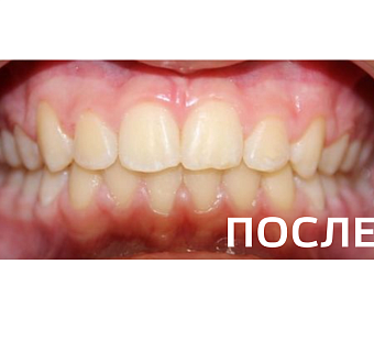 Исправление прикуса, выравнивание зубов