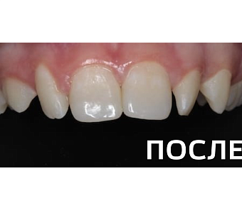 Реставрация зубов