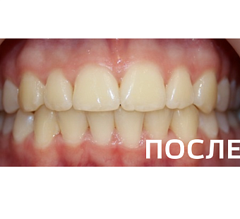 Исправление прикуса, выравнивание зубов