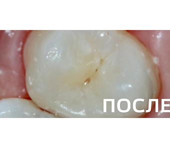 Лечение контактного кариеса премоляра