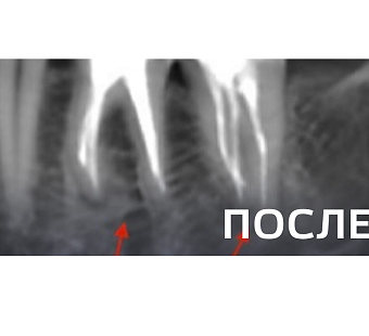 Лечение периодонтита