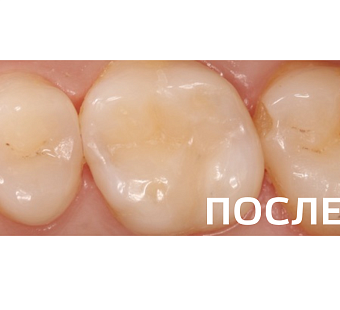 Лечение кариеса дентина