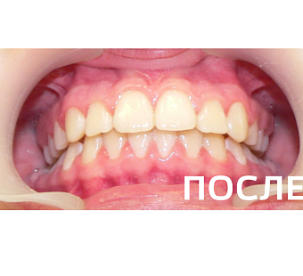 Исправление прикуса, выравнивание зубов