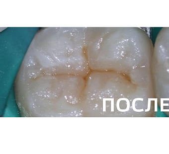 Лечение фиссурного кариеса нижнего моляра