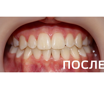 Исправление прикуса, выравнивание зубов