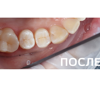Лечение кариеса