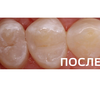 Лечение кариеса 