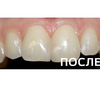 Замена несостоятельных реставраций