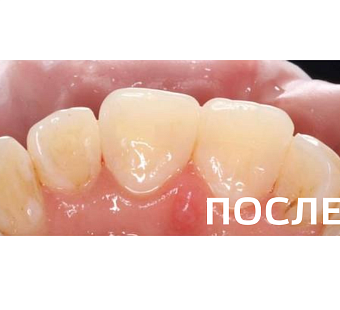 Лечение кариеса