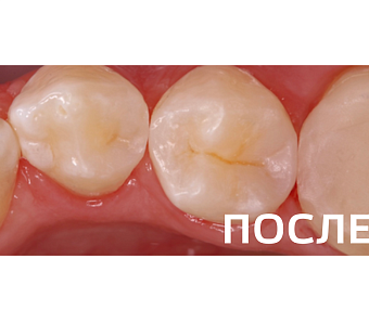 Лечение кариеса