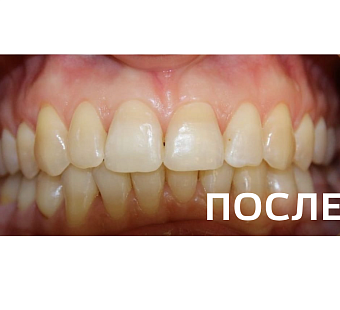 Исправление прикуса, выравнивание зубов