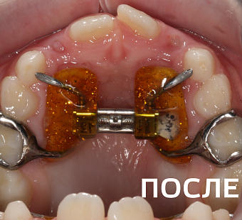 Исправление прикуса несъемными аппаратами