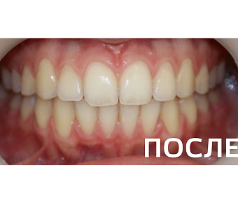 Исправление прикуса, выравнивание зубов
