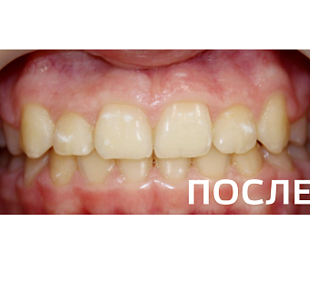 Исправление прикуса, выравнивание зубов